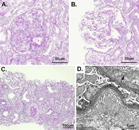 Figure The Renal Biopsy Findings A And B Photomicrographs Of The