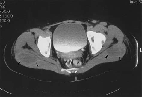 Bilateral Gluteal Abscesses As A Unique Manifestation Of Fusobacterium