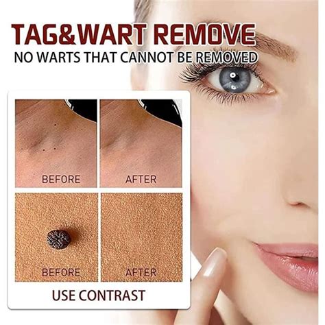 Wipeoff Tags Moles Remover Wipe Off Tags And Mole Remover Extreme