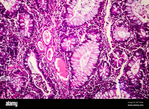 Villous Colon Adenocarcinoma Light Micrograph Photo Under Microscope