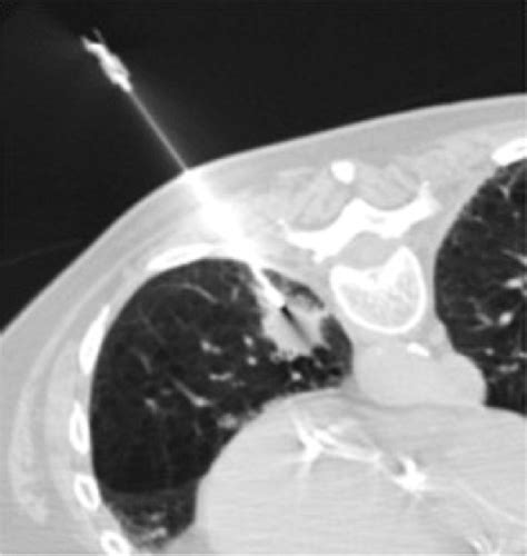 Ct Guided Lung Biopsy Effect Of Biopsy Side Down Position On