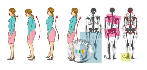 Las Malas Postura Y Sus Consecuencias Para La Salud