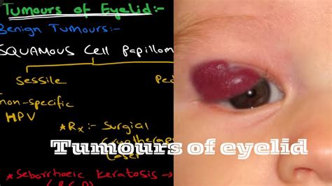 Tumors Of Eyelid Benign Tumors Malignant Tumors Youtube