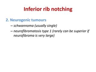 Rib notching | PPT