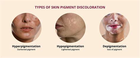 Skin Pigmentation : Causes, Types & Treatments | Dr. Priti Shukla