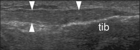 Iliotibial Band Ultrasound