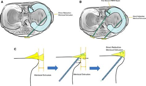 Meniscus Root Tear Sun Orthopaedic