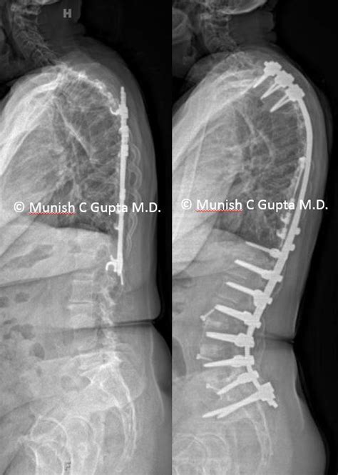 Adult Idiopathic Scoliosis Munish C Gupta Md