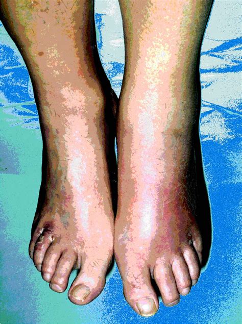 Pdf Management Of Lower Leg Cellulitis Semantic Scholar