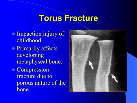 Torus Fracture