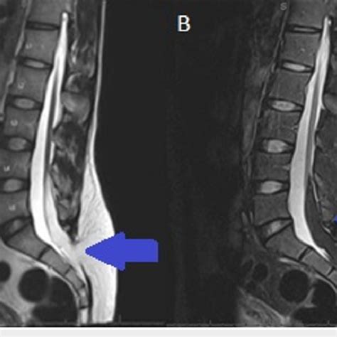 Lumbar Spine Sagittal View Showing Findings Of Tethered Spinal Cord