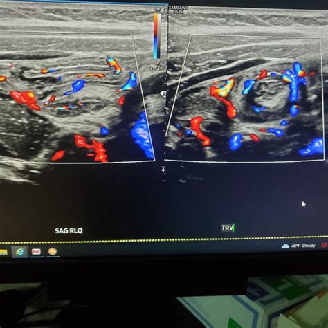 Intussusception And Normal Appendix On Ultrasound R Radiology