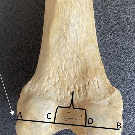 Shows The Measurements Of The Bicondylar And Intercondylar Notch Width