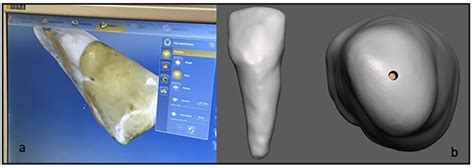 Revista Canal Abierto Surgical Static Guides In Endodontics Use And