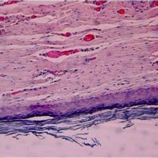 Histopathological Examination Of The Surgical Specimen Revealed Cystic