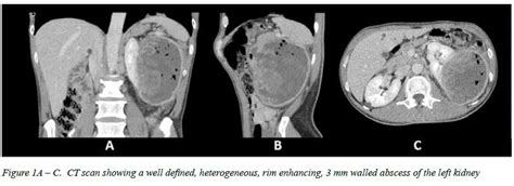 Papillary Renal Cell Carcinoma Presenting As A Renal Abscess