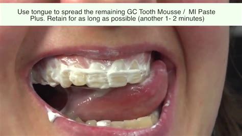 2 Methods To Use Gc Tooth Mousse I Tooth Mousse Plus I Mi Paste Youtube