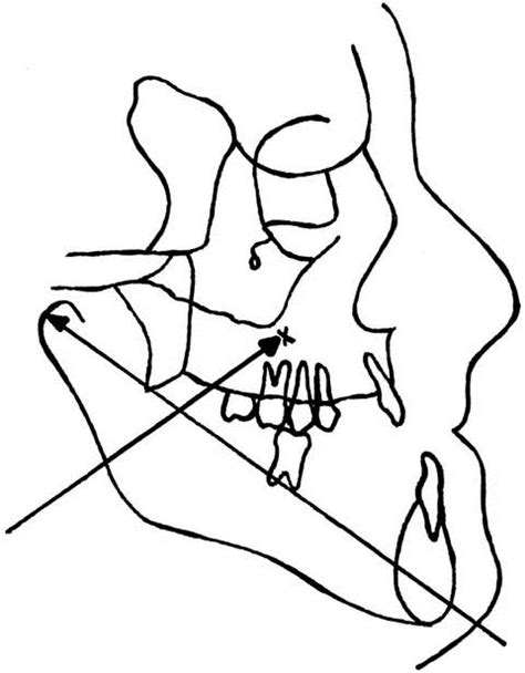 Design And Fabrication Of A Modified Protraction Headgear For Class Iii Long Face Patients