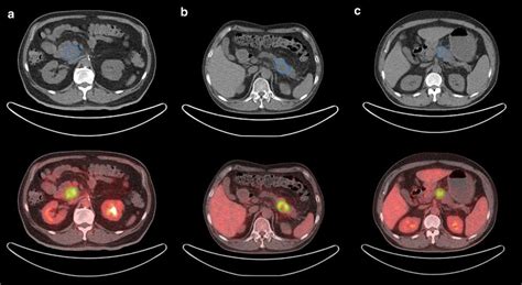 Examples Of Roi Segmentation In Pancreatic Ductal Adenocarcinoma Pdac