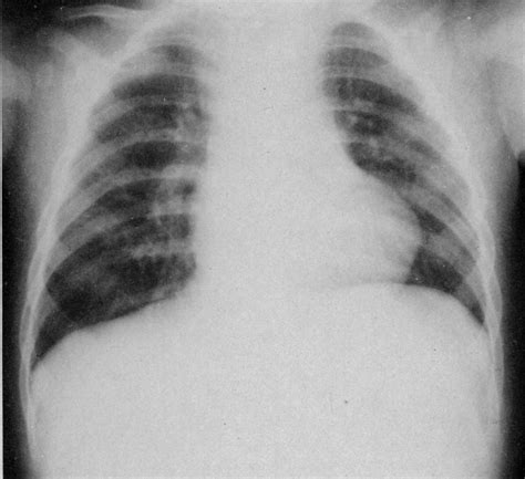 Case 8 1987 A 44 Month Old Girl With Fever Of Unknown Origin After