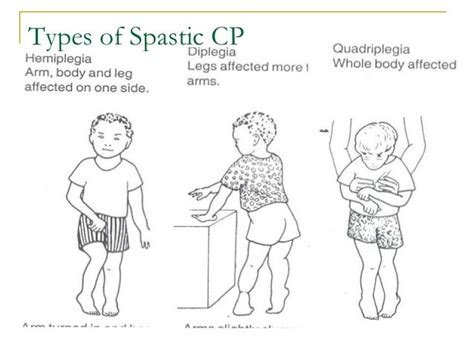 palsy cerebral spastic types cp hemiplegia children spasticity
