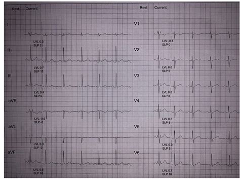 Case Report Of An Atrial Septal Defect With Negative Transthoracic