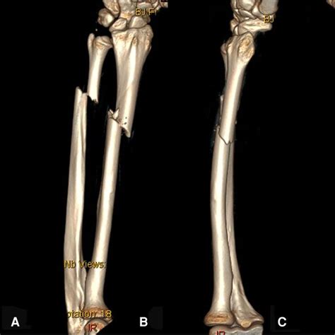 Preoperative Three Dimensional Reconstructive CT Images AD Of The