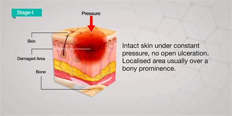 Pressure Ulcer Causes | Stages | Treatment | Axio Biosolutions