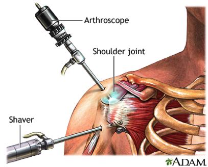 Shoulder Arthroscopy Cal Sports Orthopaedic Institute Orthopaedic