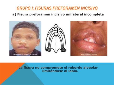 Fisura Labio Naso Alveolo Palatina Ppt Descarga Gratuita