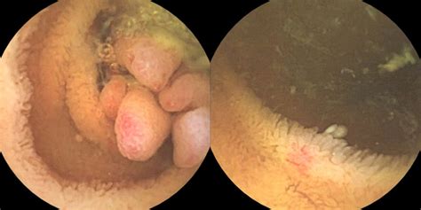 Hereditary Hemorrhagic Telangiectasia Endoscopy