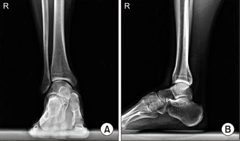 Right Ankle Anteroposterior A And Lateral B Radiographs Of A