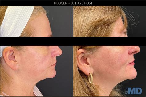 NeoGen Skin Regeneration Treatments Skin MD Laser Cosmetic Group