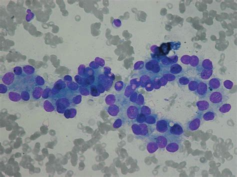 Fine Needle Aspiration Cytology Of The Follicular Variant Of Papillary