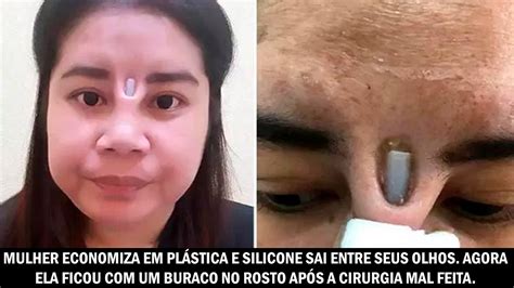 Mulher economiza em plástica e silicone sai entre seus olhos Agora ela