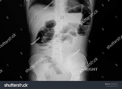 Abdominal Supine X Ray Film Male Patient Stock Photo 1606938547