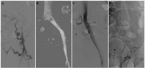 A Pre Interventional Venography Of The Left Iliac Tract In A Patient