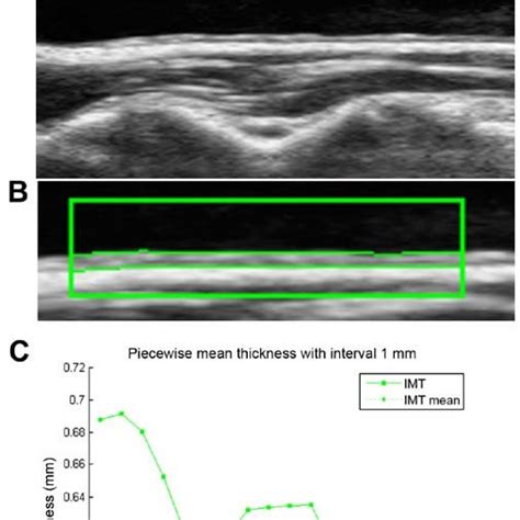 Carotid Imt And Intima Media Roughness Measurements A Ultrasound