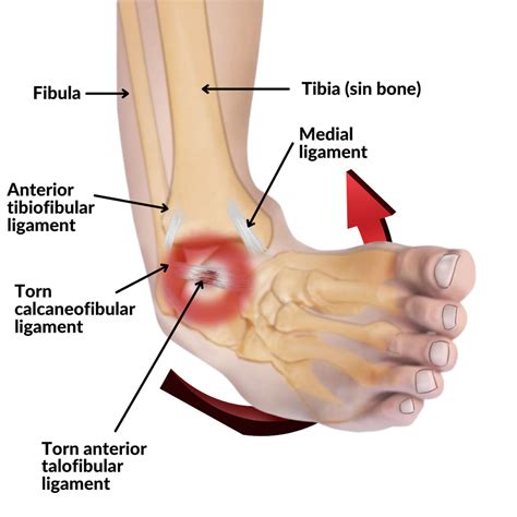 Can Chiropractic Care Help With Chronic Ankle Sprains — Chiroup