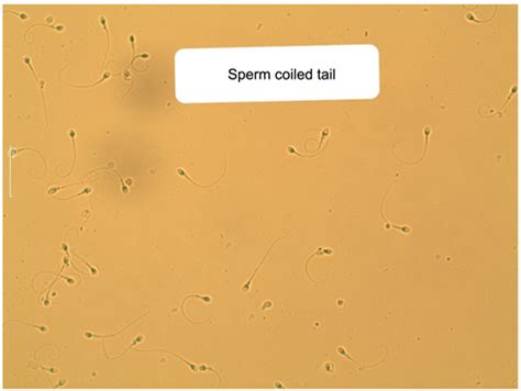 A Study On Infertility Of Males Infected With Mycoplasma Hominis With