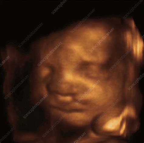 Cleft Lip 3d Ultrasound