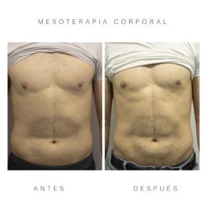 Mesoterapia Corporal Adi S A La Grasa Localizada Cl Nica Opci N M Dica