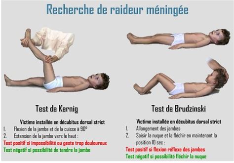 Syndrome méningé Cartes Quizlet