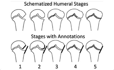 Classification Of The Ossification Of The Proximal Humerus The