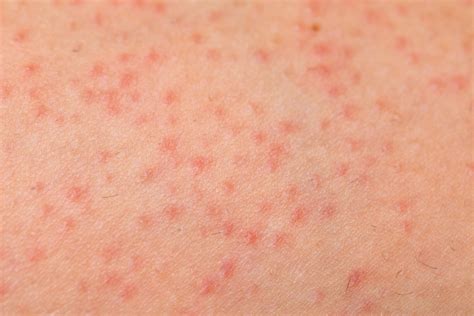 Folliculitis Auckland Skin Clinic