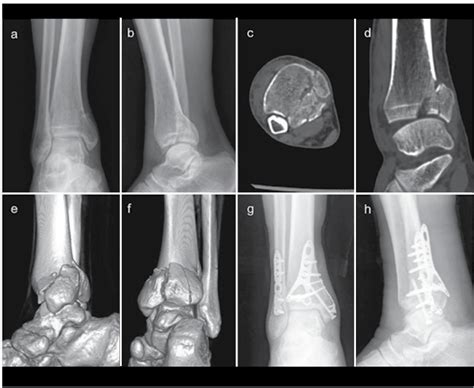 Scielo Brasil Open Reduction And Internal Fixation Of Posterior Pilon