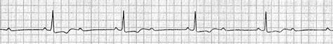 2nd Degree AV Block Type 2 Strip