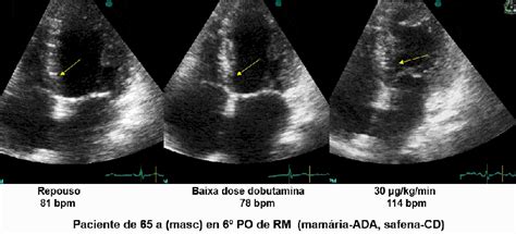 Ecocardiografia De Estresse Parte 4 Blog Ecope