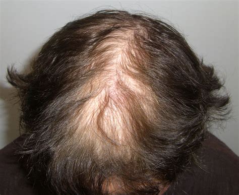 Hair Loss Hair Replacement Before And After Photos Richard Kroll