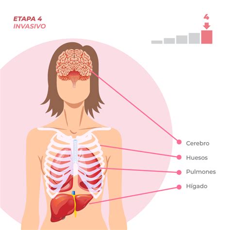 Estad Os Del C Ncer De Mama Festival De La Mujer